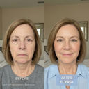 ELYVIA Micro-Infusion Kit™