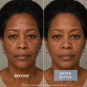 ELYVIA Micro-Infusion Kit™