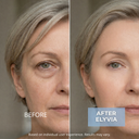 ELYVIA Micro-Infusion Kit™