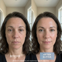 ELYVIA Micro-Infusion Kit™