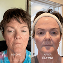 The Micro Infusion System™