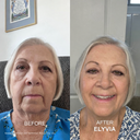 The Micro Infusion System™