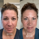 The Micro Infusion System™