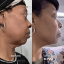 The Micro Infusion System™