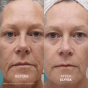 The Micro Infusion System™