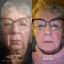 The Micro Infusion System™