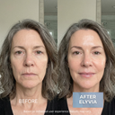 ELYVIA Micro-Infusion Kit™