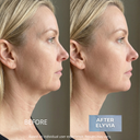 ELYVIA Micro-Infusion Kit™